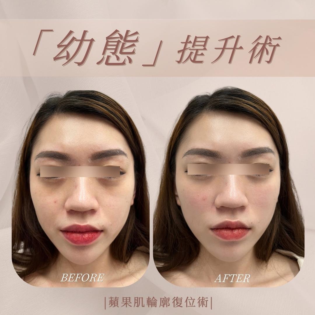 幼態提升術 - 馥之美診所美麗見證