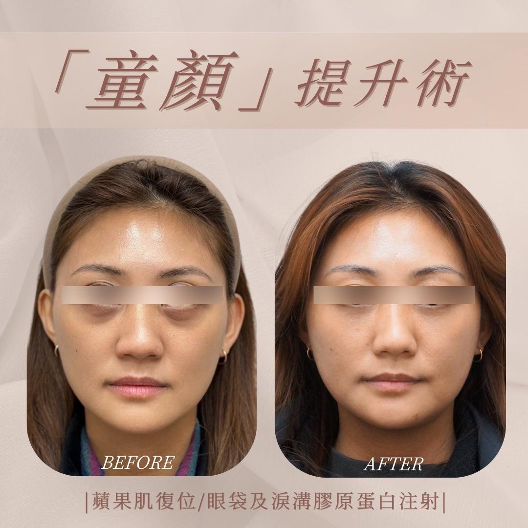 幼態提升術 - 馥之美診所美麗見證