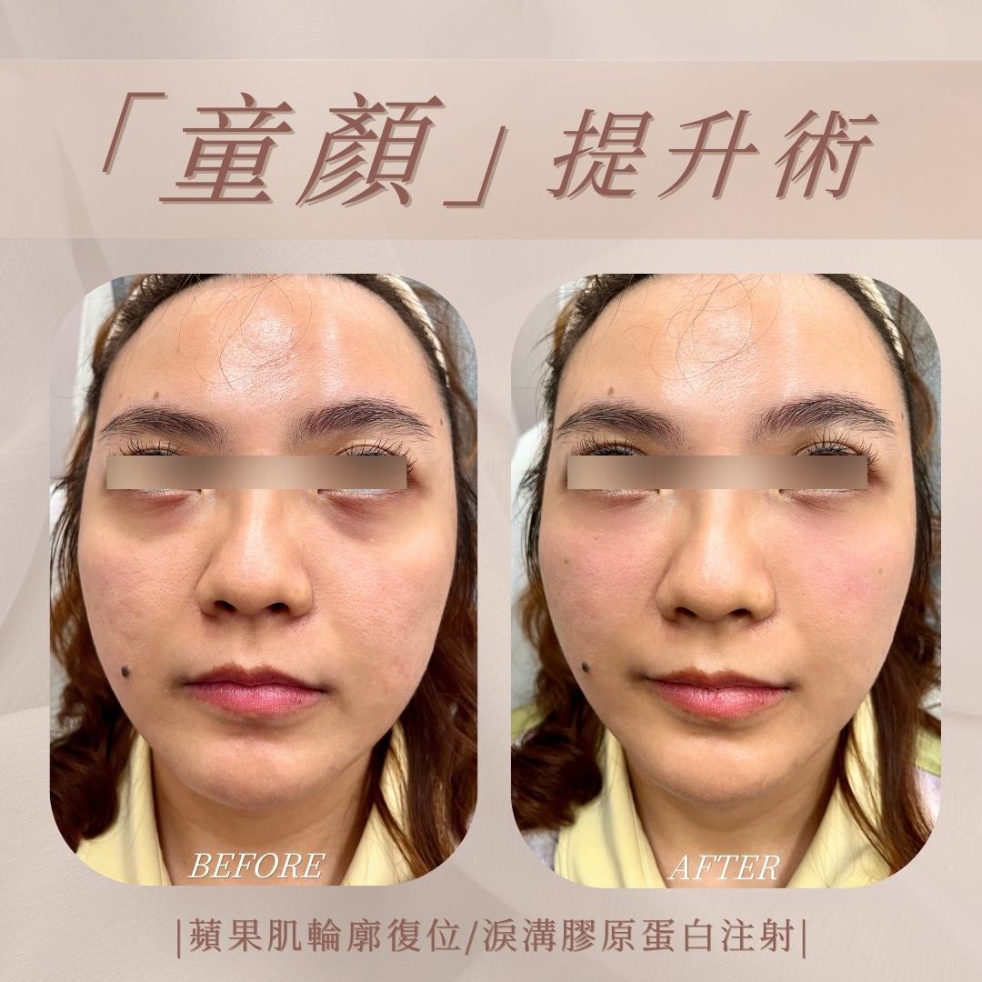 幼態提升術 - 馥之美診所美麗見證