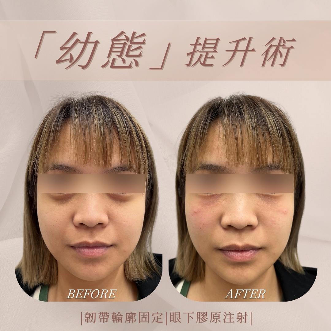 幼態提升術 - 馥之美診所美麗見證