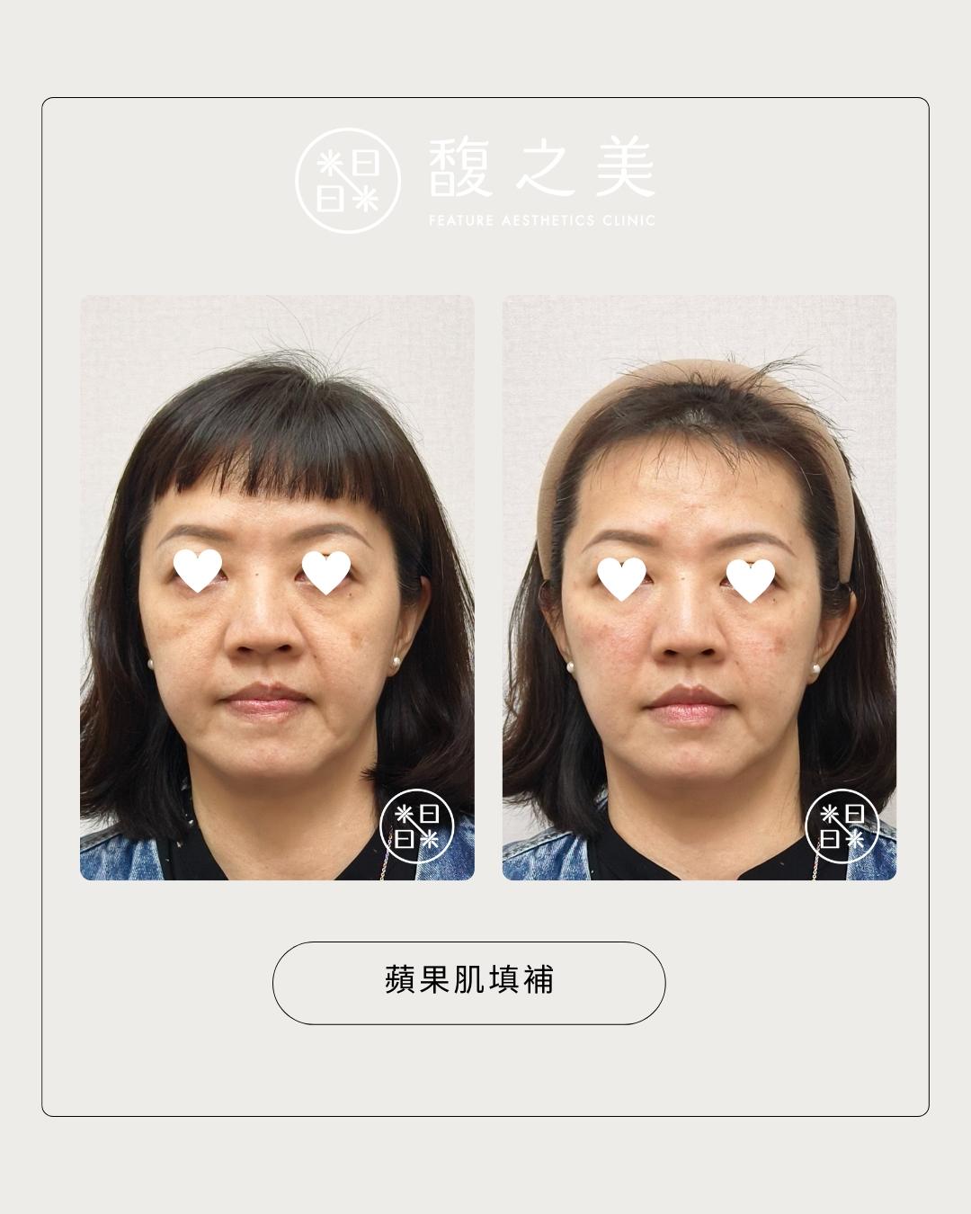 幼態提升術 - 馥之美診所美麗見證