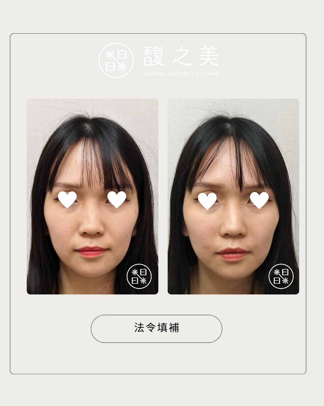 幼態提升術 - 馥之美診所美麗見證