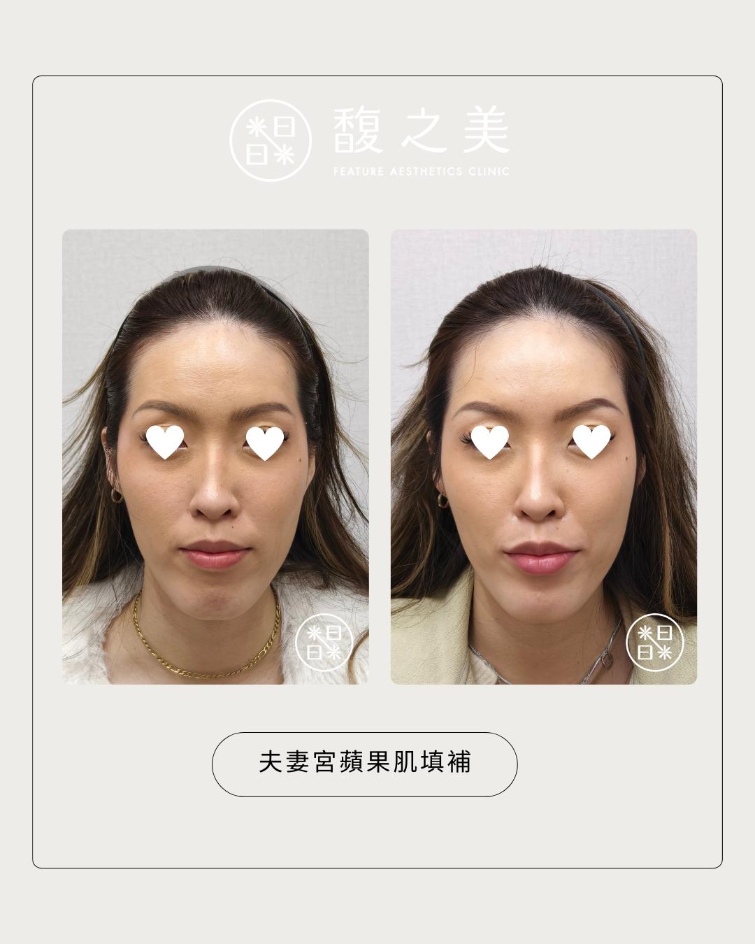 幼態提升術 - 馥之美診所美麗見證