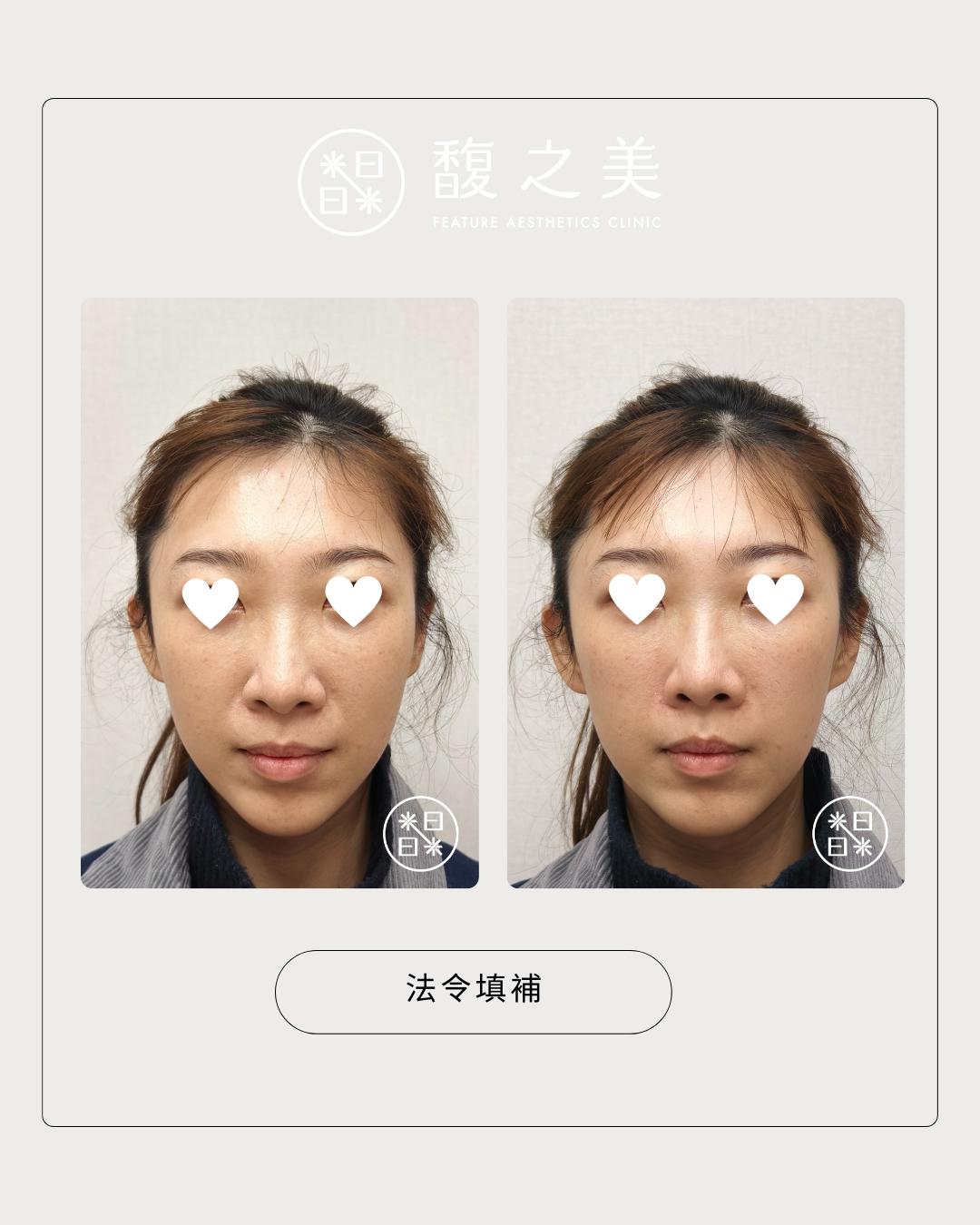 幼態提升術 - 馥之美診所美麗見證